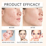 Sérum Visage à l’Acide Salicylique Anti-Acné